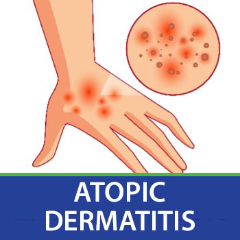 atopic dermatitis slide