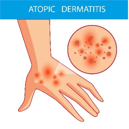 Atopic dermatitis eczema clinical trials